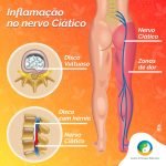 Tratamento para inflamação do nervo ciático
